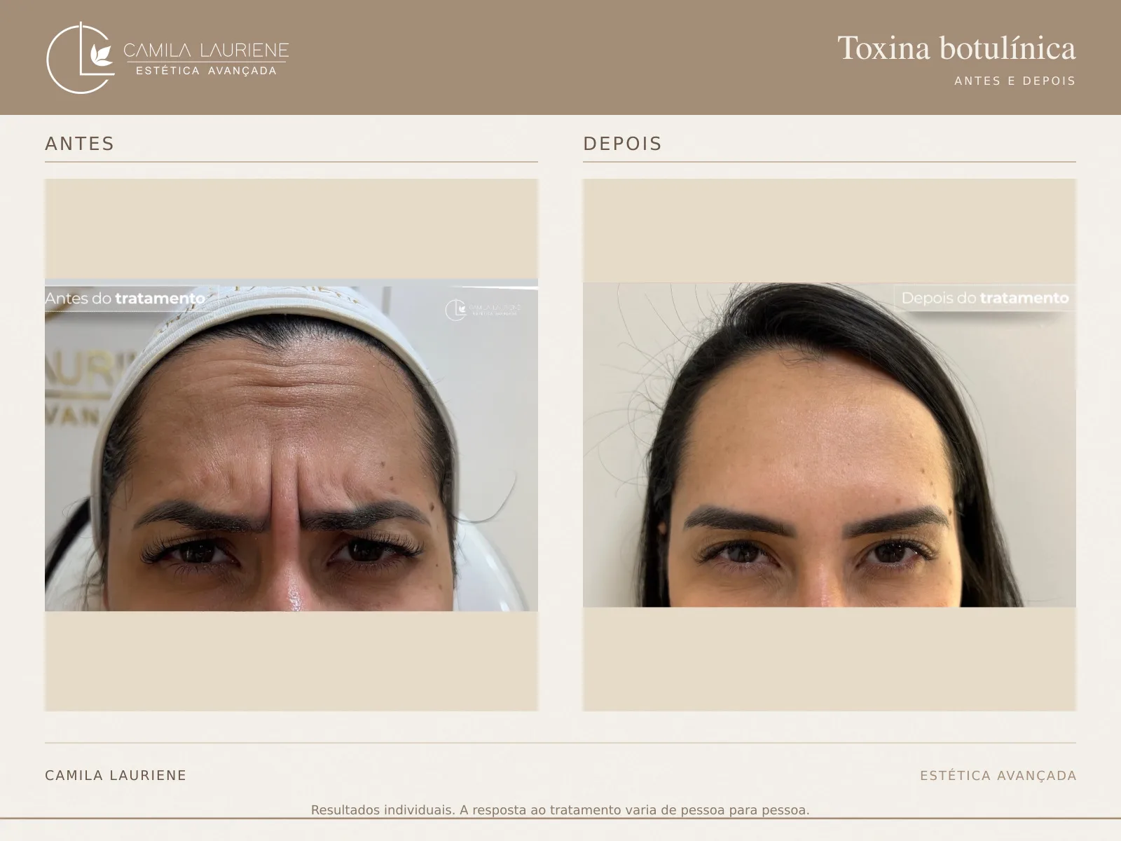 Antes e depois de botox · glabela realizado pela Dra. Camila Lauriene