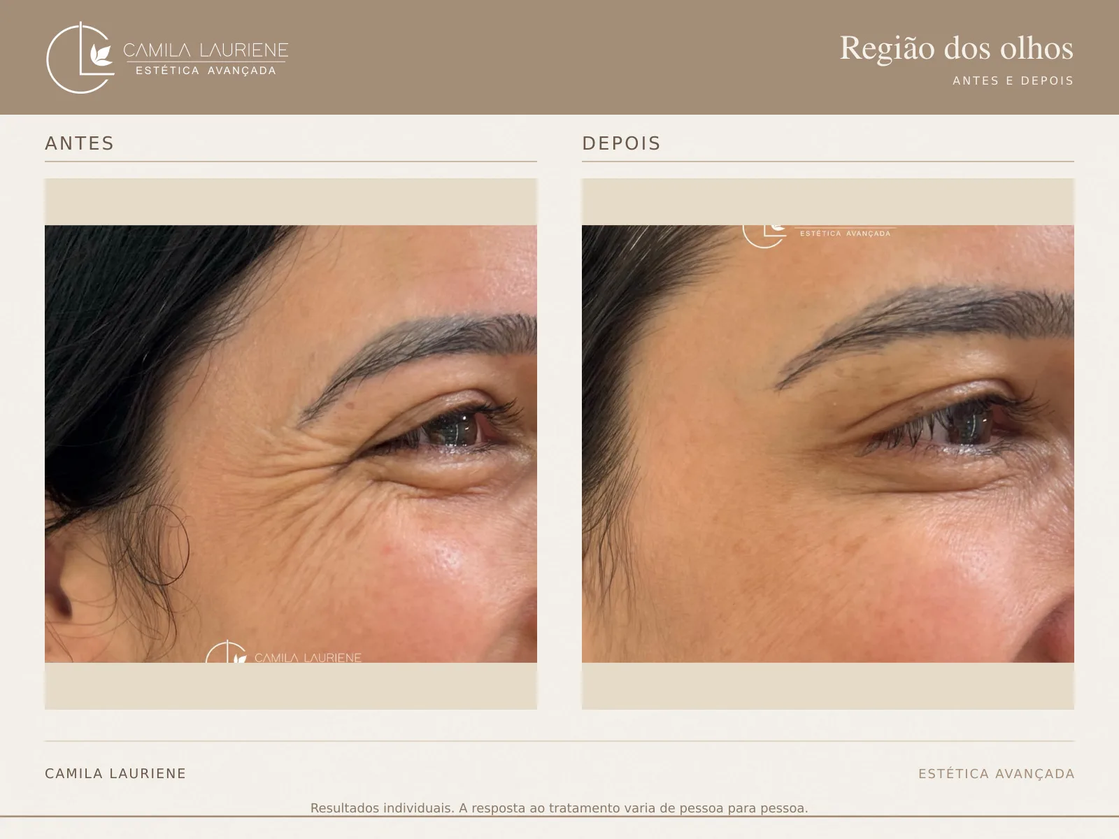 Antes e depois de região dos olhos realizado pela Dra. Camila Lauriene