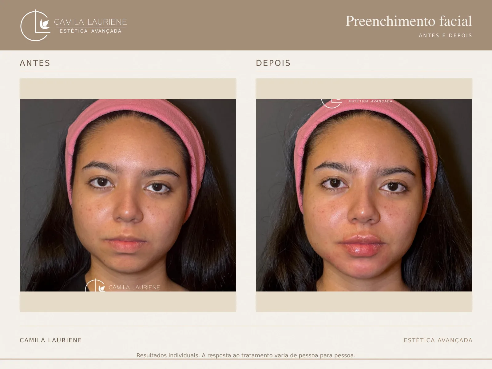 Antes e depois de preenchimento facial realizado pela Dra. Camila Lauriene