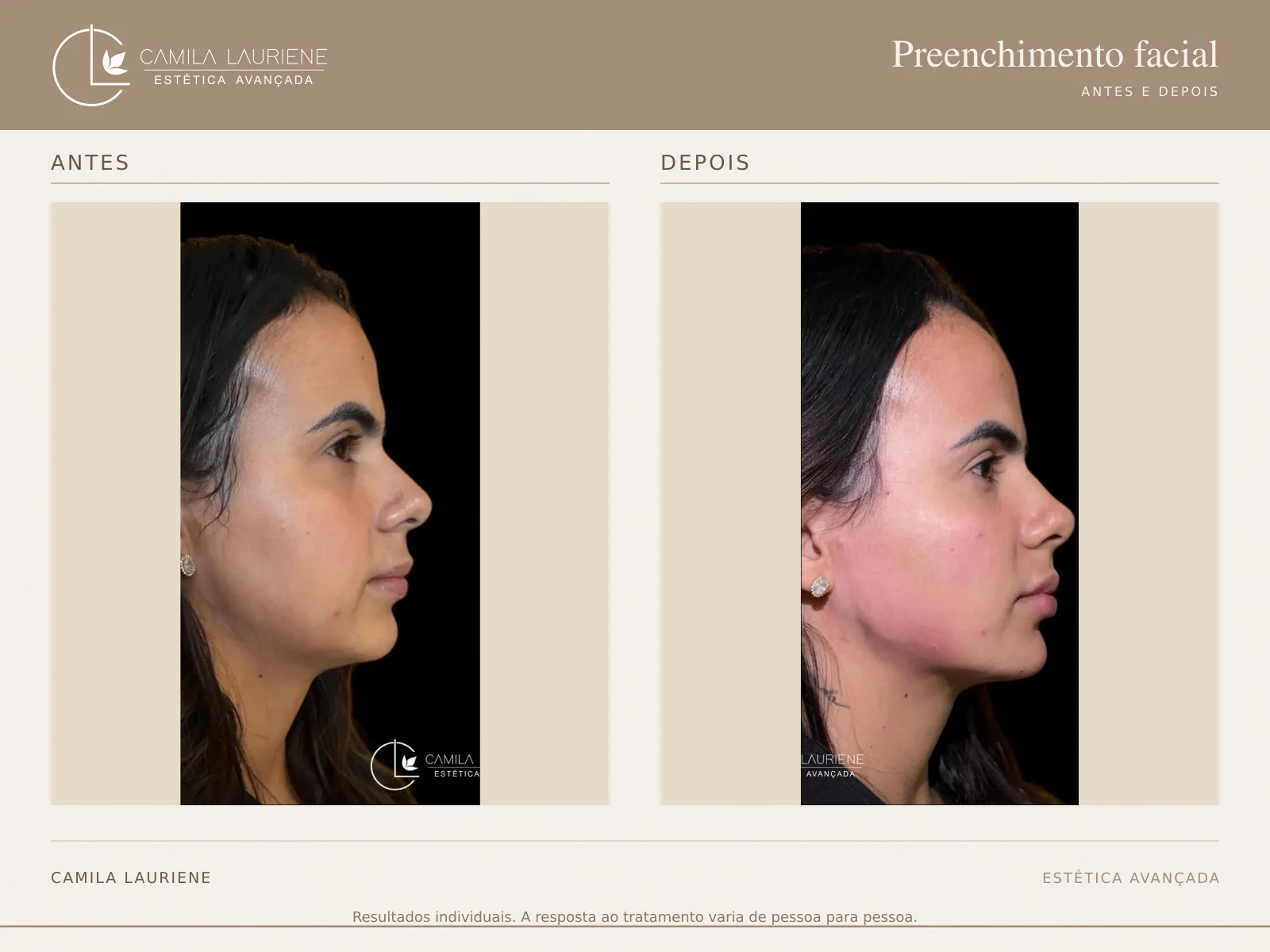 Antes e depois de preenchimento facial · perfil realizado pela Dra. Camila Lauriene