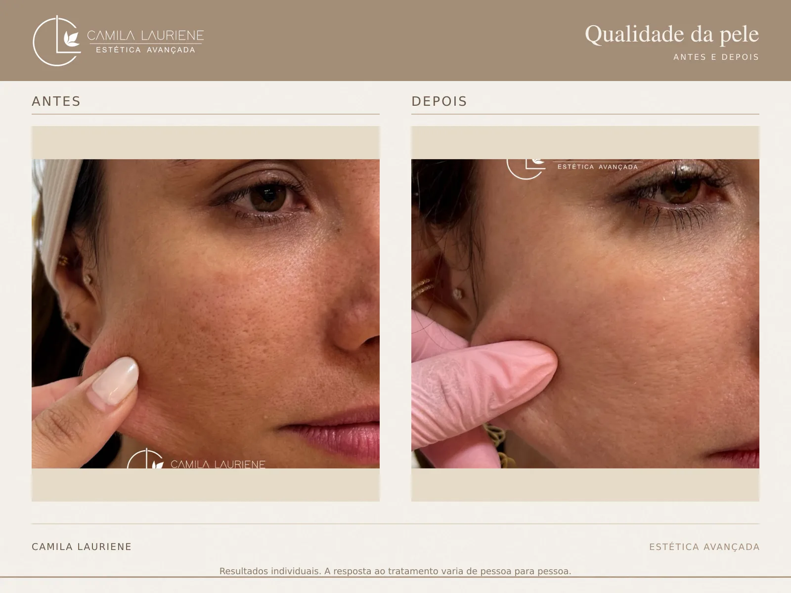 Antes e depois de qualidade da pele realizado pela Dra. Camila Lauriene