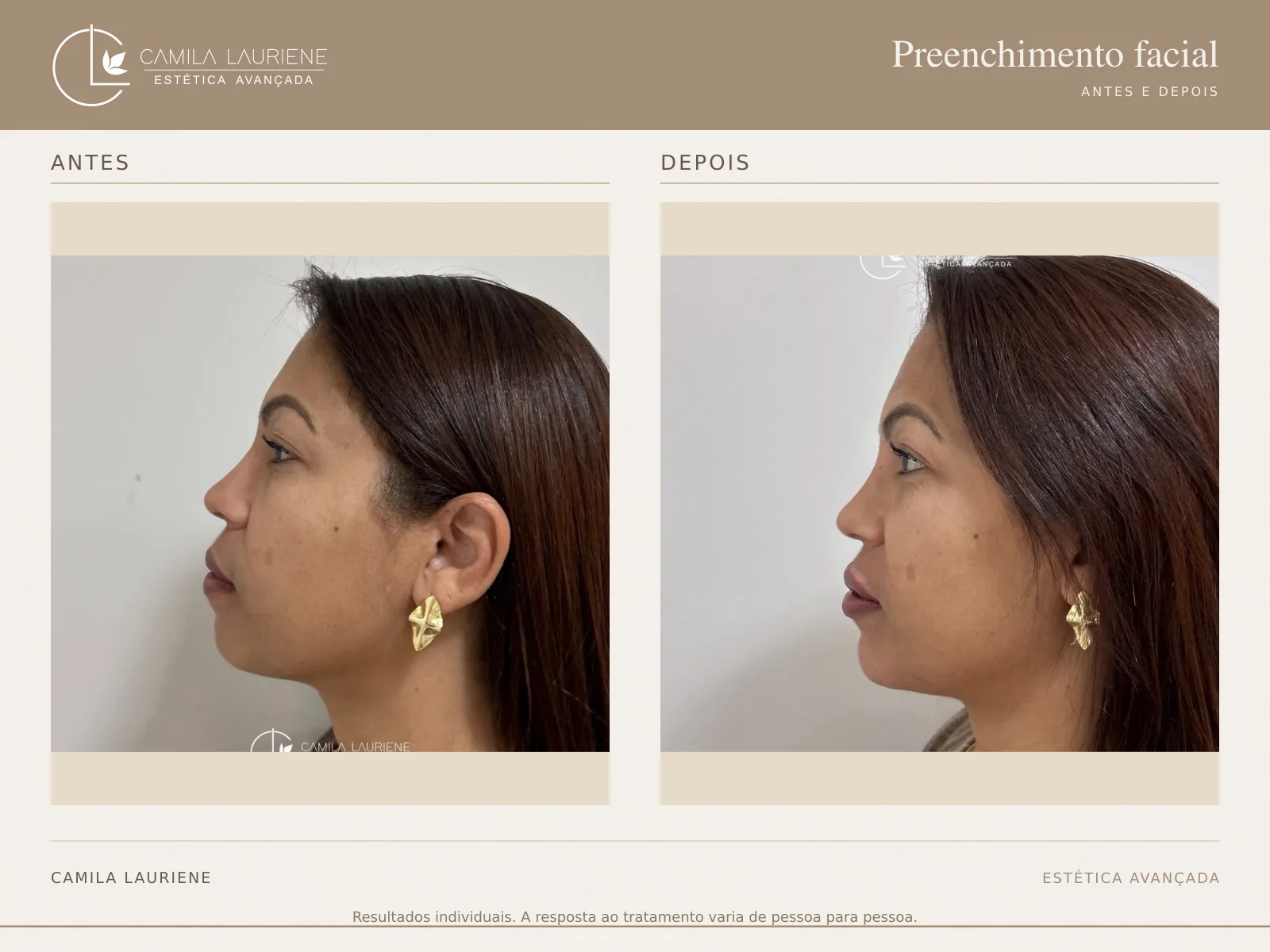 Antes e depois de preenchimento facial · perfil realizado pela Dra. Camila Lauriene