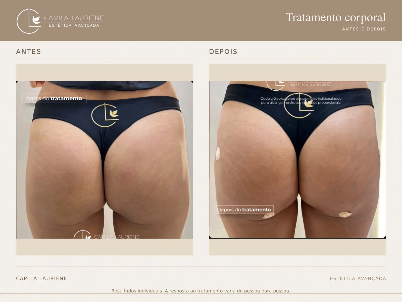 Antes e depois de tratamento corporal realizado pela Dra. Camila Lauriene
