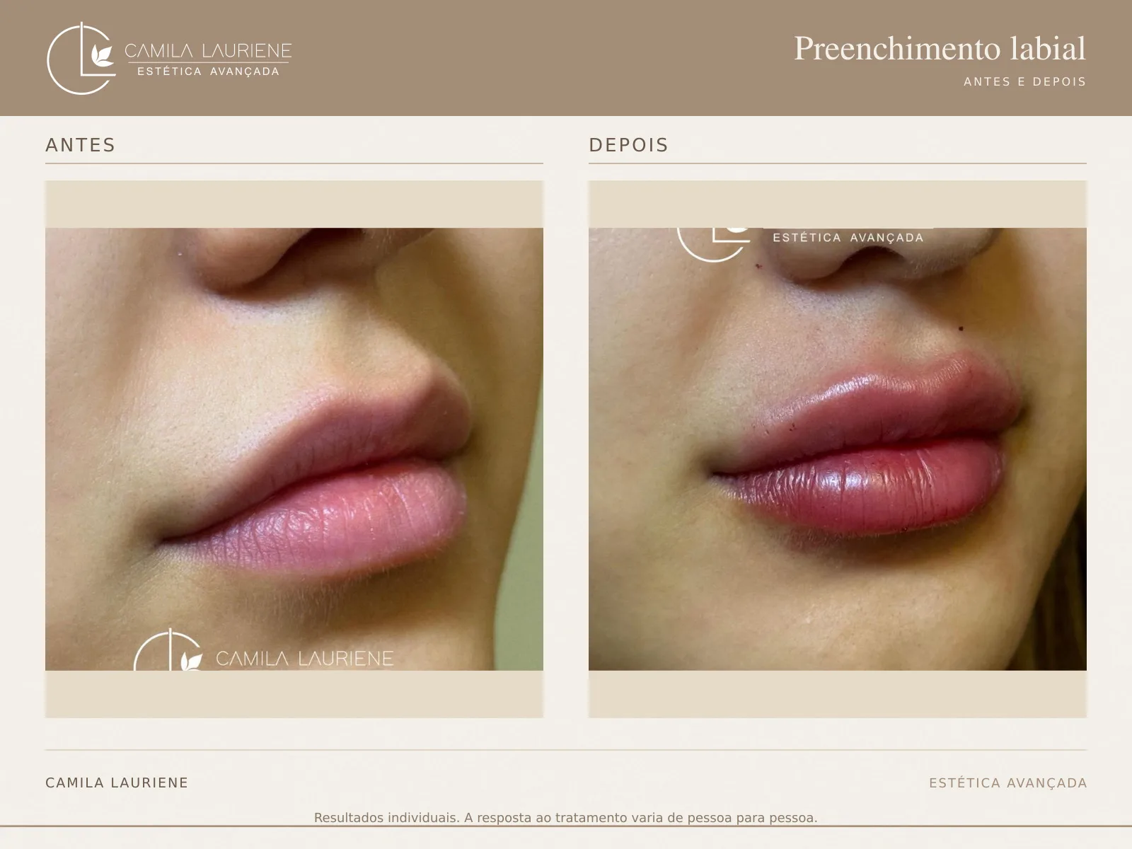 Antes e depois de preenchimento labial realizado pela Dra. Camila Lauriene