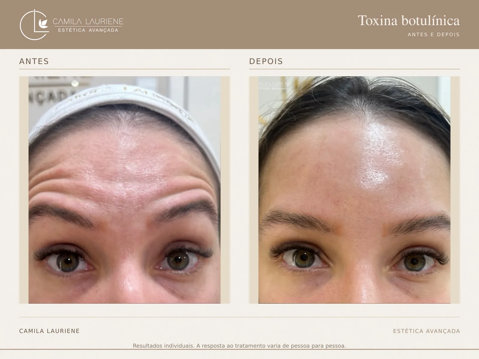 Antes e depois de botox · comparativo realizado pela Dra. Camila Lauriene