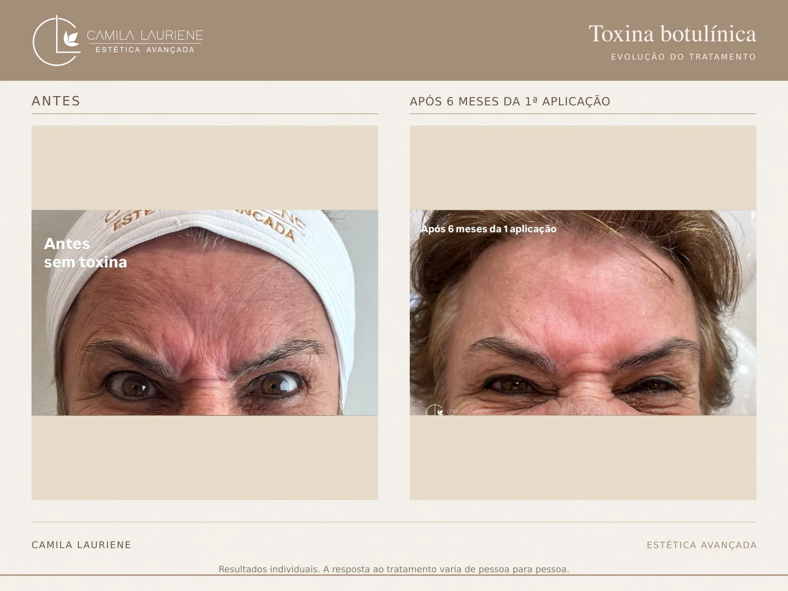 Antes e depois de botox · evolução em 6 meses realizado pela Dra. Camila Lauriene